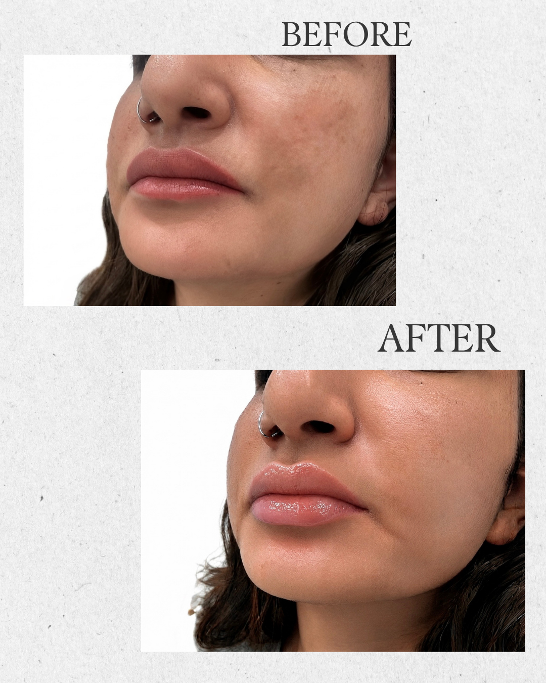 Before and after lip enhancement results