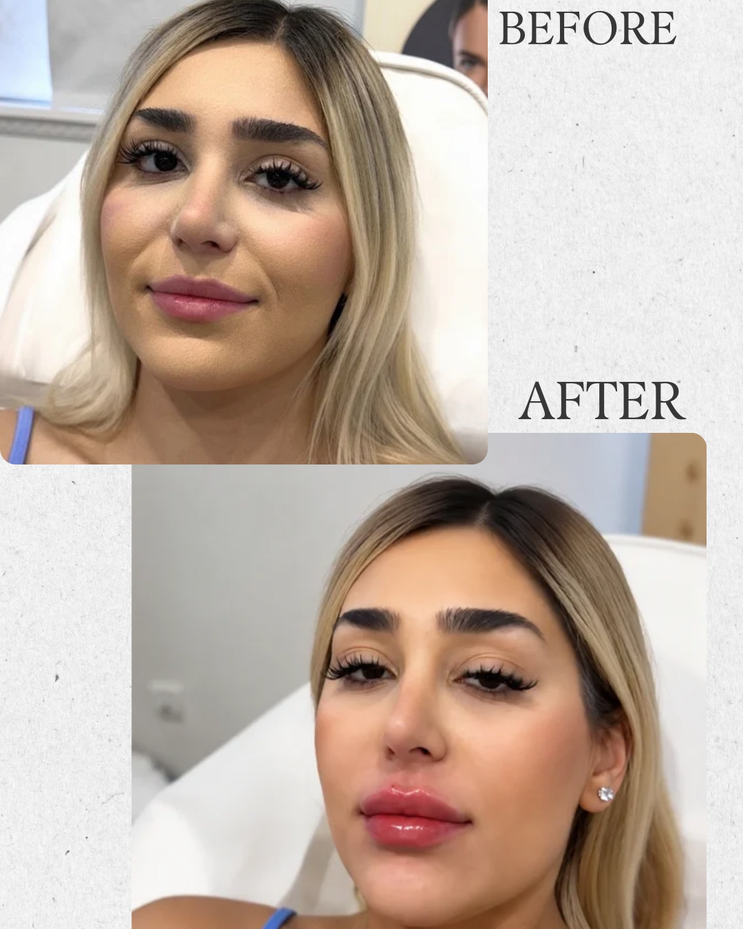 Before and after lip enhancement results