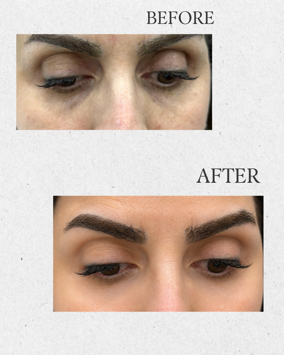 Before and after under-eye treatment results